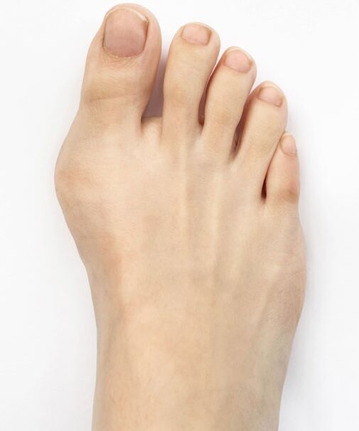 hallux valgus преди да използвате Hondro Sol Valgus спрей